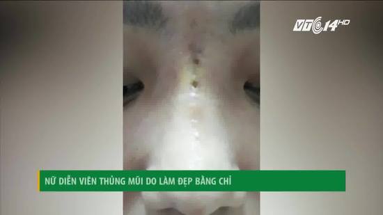 VTC14: Nữ diễn viên bị thủng mũi do làm đẹp bằng chỉ